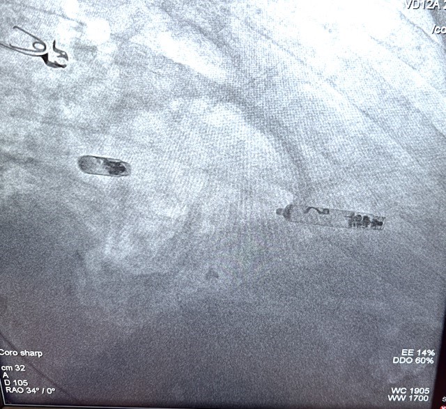 A radiographic image of the AVEIR™ DR, the World’s First Dual Chamber Leadless Pacemaker System by Abbott, taken in the William Newton Hospital cardiovascular catheterization lab.